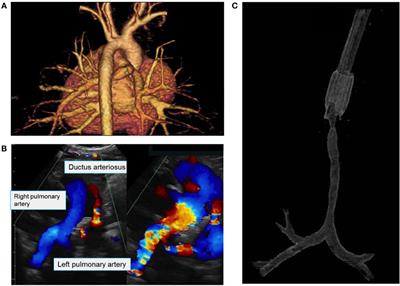 Complicated Postoperative Course after Pulmonary Artery Sling Repair and Slide Tracheoplasty